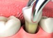 Studio Dentistico dott.ri Paolo e Cristina Papa | Medici Chirurghi Odontoiatri a Napoli: estrazione del dente