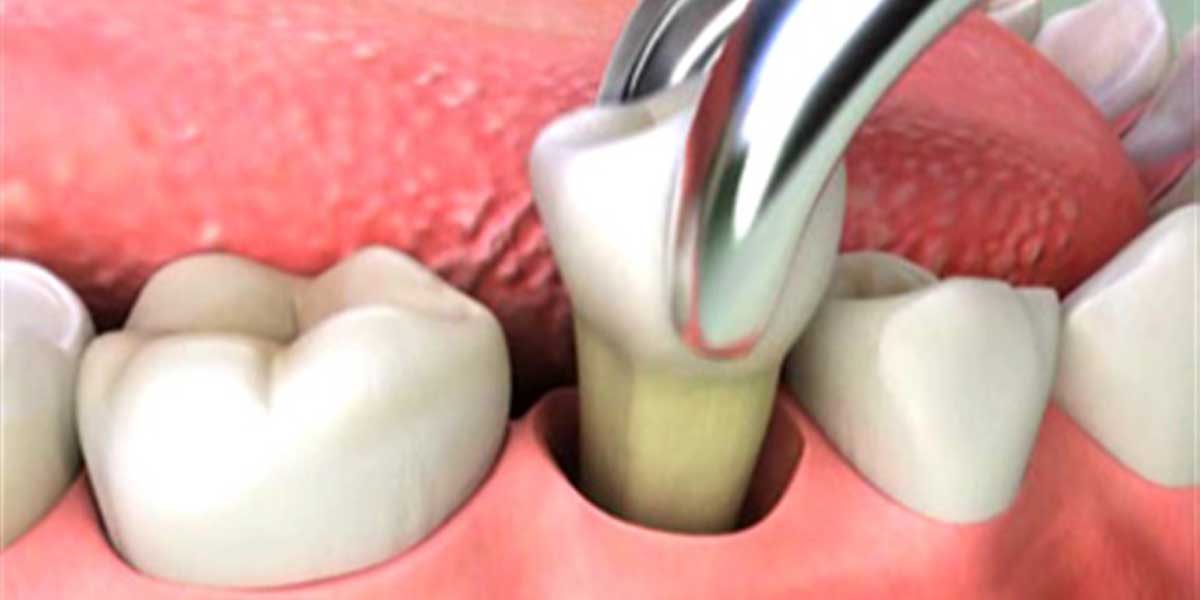 Studio Dentistico dott.ri Paolo e Cristina Papa | Medici Chirurghi Odontoiatri a Napoli: estrazione del dente