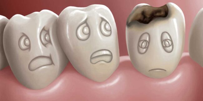 Studio Dentistico dott.ri Paolo e Cristina Papa | Medici Chirurghi Odontoiatri a Napoli: carie dentaria
