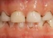 Studio Dentistico dott.ri Paolo e Cristina Papa | Medici Chirurghi Odontoiatri a Napoli: cosa sono le Black Stains