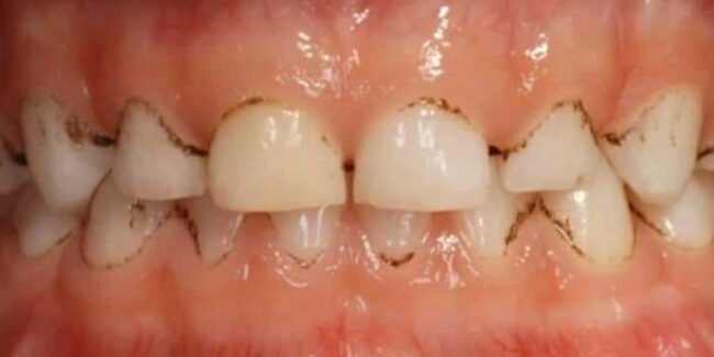 Studio Dentistico dott.ri Paolo e Cristina Papa | Medici Chirurghi Odontoiatri a Napoli: cosa sono le Black Stains