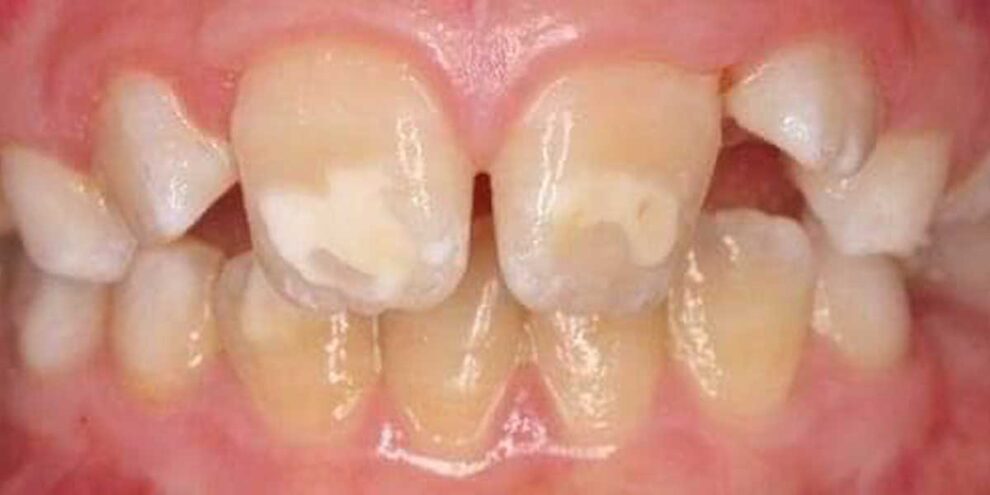 Studio Dentistico dott.ri Paolo e Cristina Papa a Napoli: che cos’è la MIH? Studio Dentistico dott.ri Paolo e Cristina Papa | Medici Chirurghi Odontoiatri a Napoli: che cos'è la MIH?