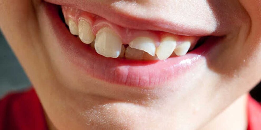 Studio Dentistico dott.ri Paolo e Cristina Papa | Medici Chirurghi Odontoiatri a Napoli: mamma, mi sono rotto il dentino! Studio Dentistico dott.ri Paolo e Cristina Papa a Napoli: mamma, mi sono rotto il dentino!