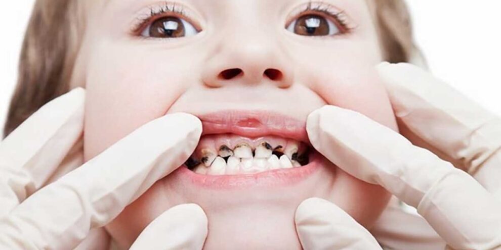 Studio Dentistico Dott. Paolo Papa a Napoli: Carie dei denti da latte, facciamo il punto.