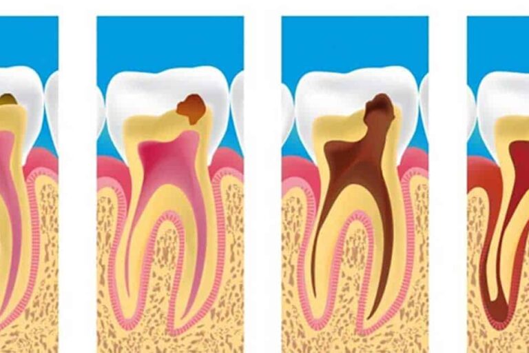 Studio Dentistico Dott. Paolo Papa a Napoli: In cosa consiste la devitalizzazione di un dente?