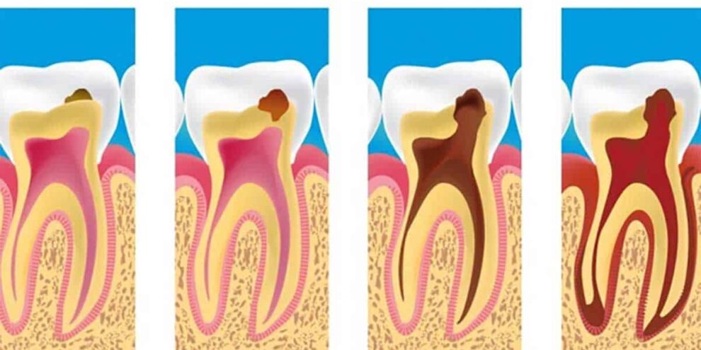 Studio Dentistico Dott. Paolo Papa a Napoli: In cosa consiste la devitalizzazione di un dente?