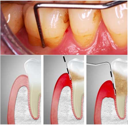 I controlli periodici presso lo Studio Dentistico Papa sono in grado di garantire un intervento tempestivo per proteggere il vostro sorriso dalle parodontopatie