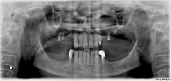 Studio Dentistico dott. Paolo Papa a Napoli: realizziamo protesi fisse o removibili, per ridare il sorriso ai nostri pazienti!