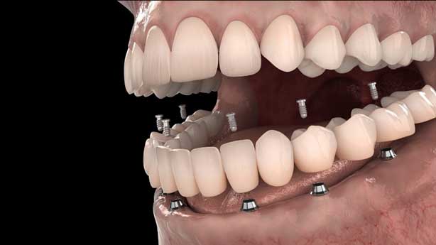 Studio Dentistico dott. Paolo Papa a Napoli: protesi su impianti che riproduce l’intera arcata dentale